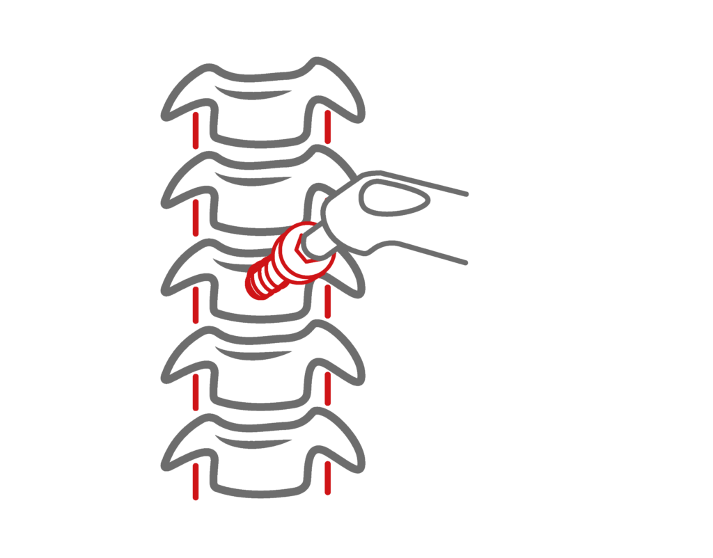 Anterior Cervical Disc fusion