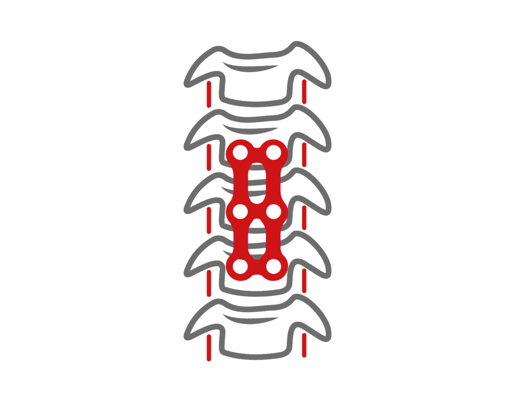 Anterior Cervical Plate System