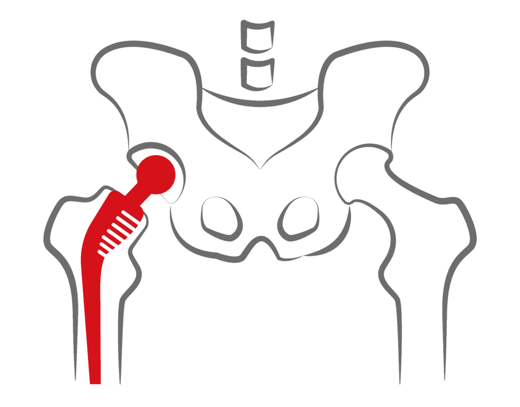 Hip Replacement