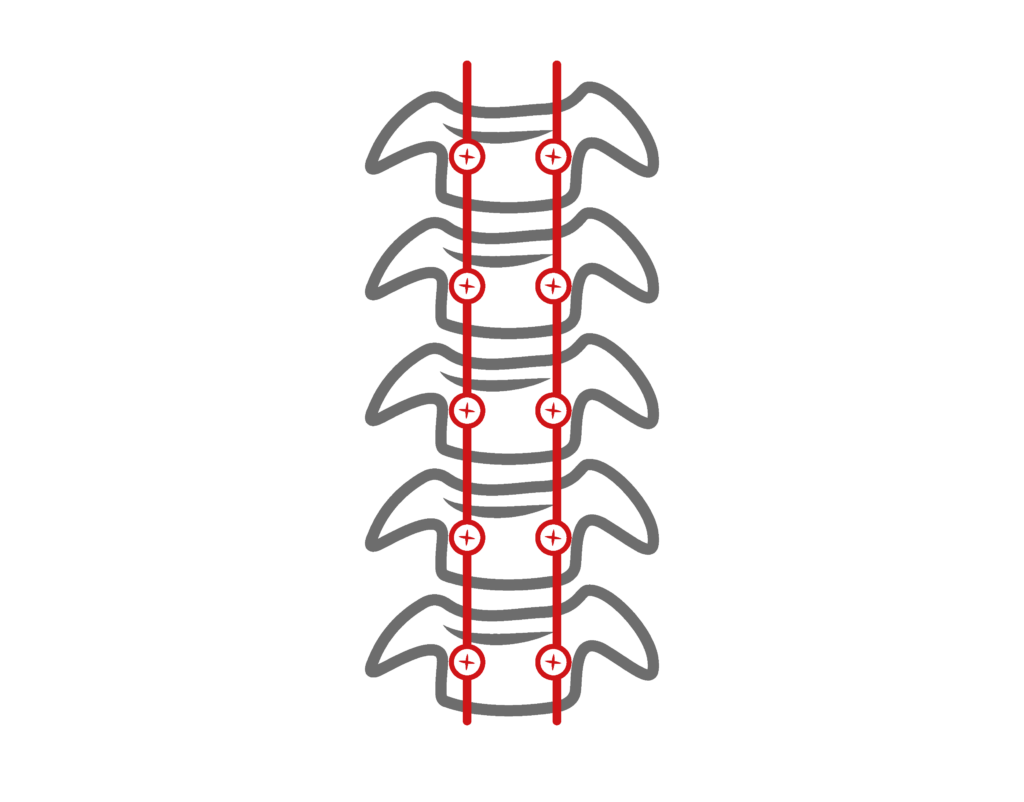 Pedicle Screws - Spinal Fusion