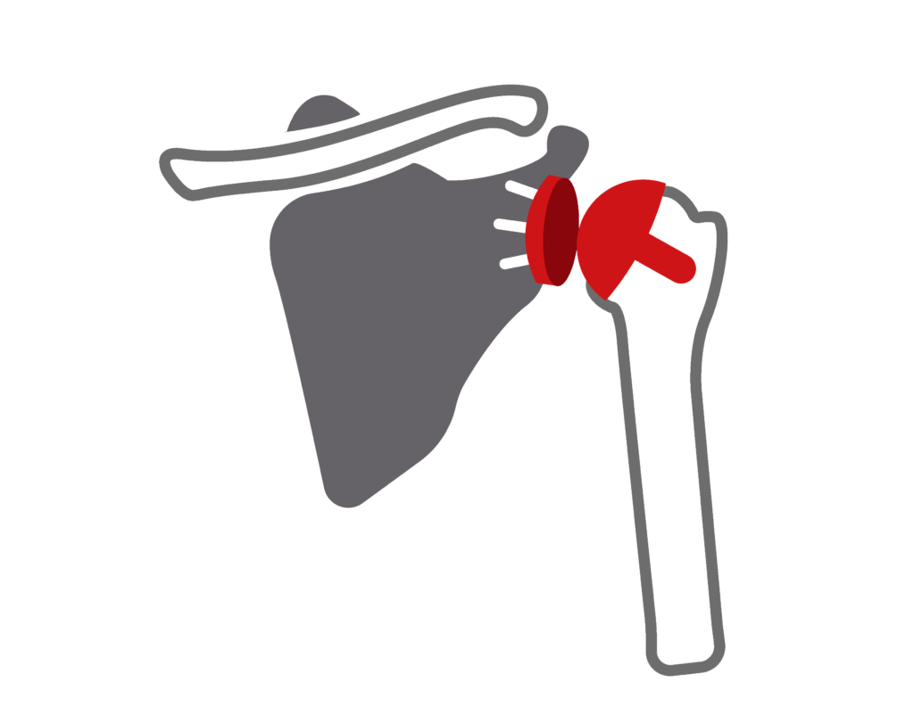 Shoulder Arthroplasty