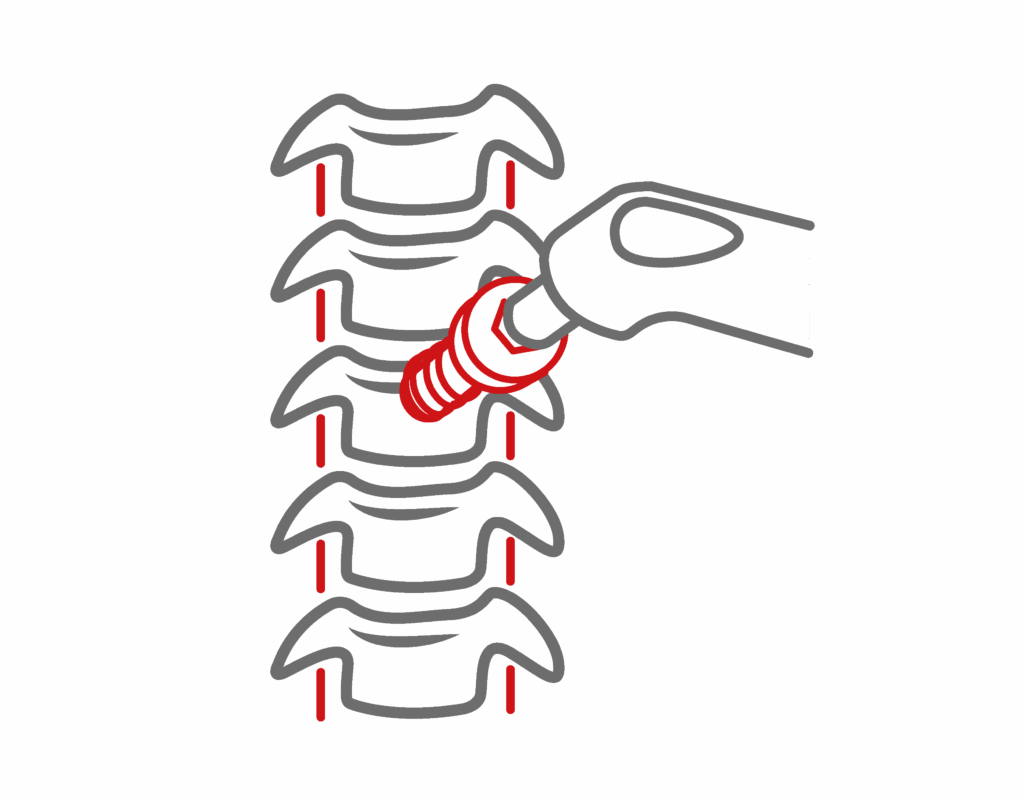 Anterior Cervical Disc fusion